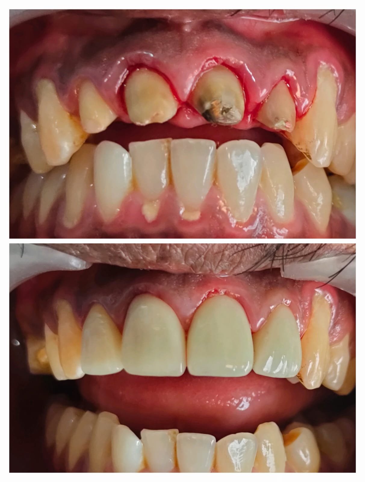 Smile transformation 1