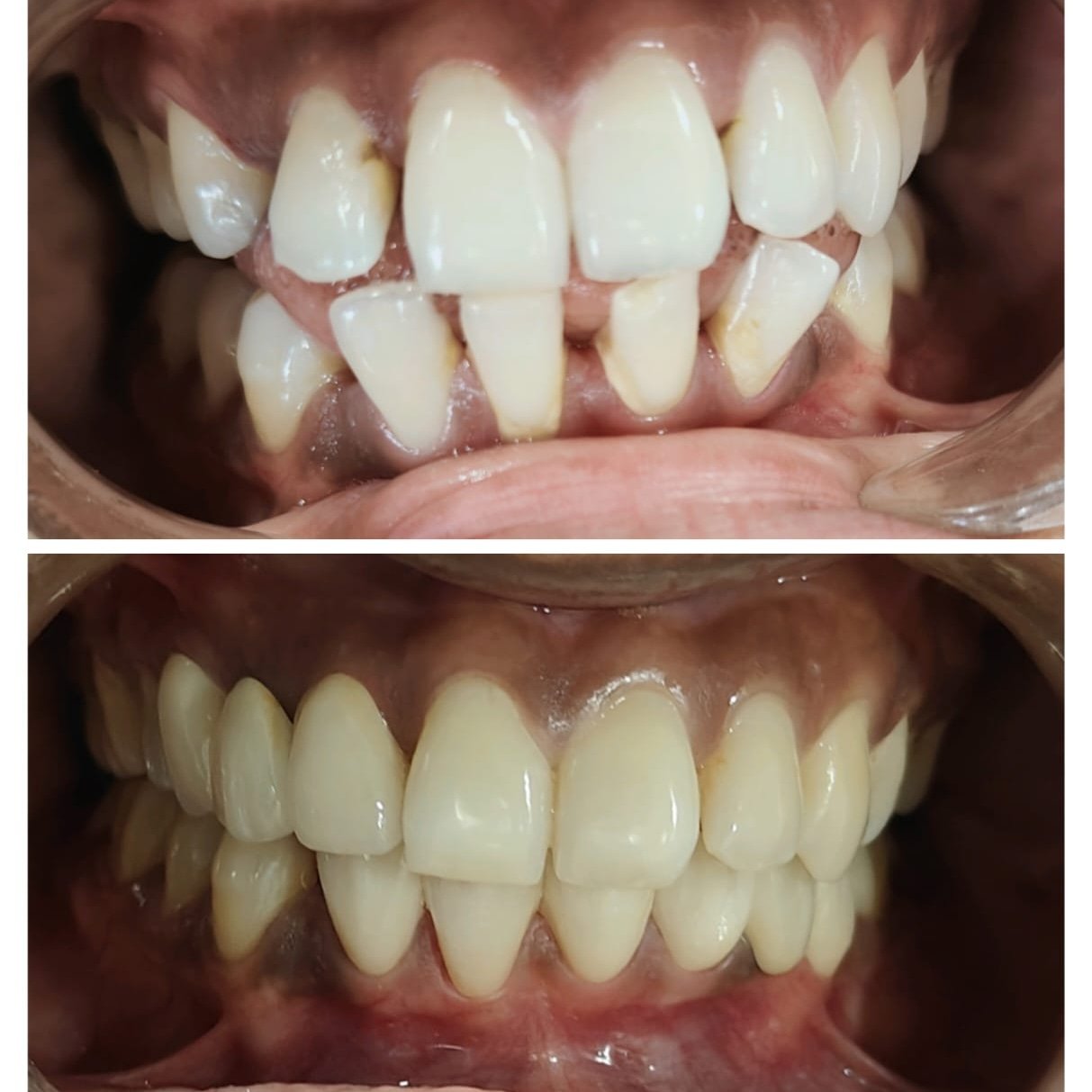 Smile transformation 3