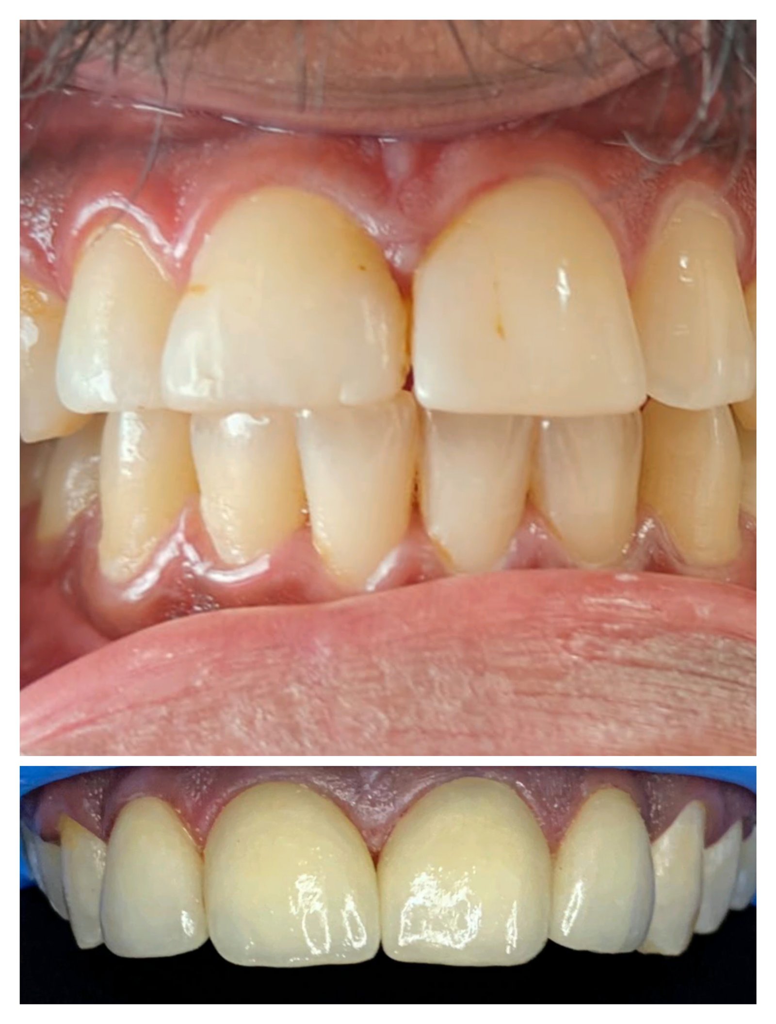 Smile transformation 6