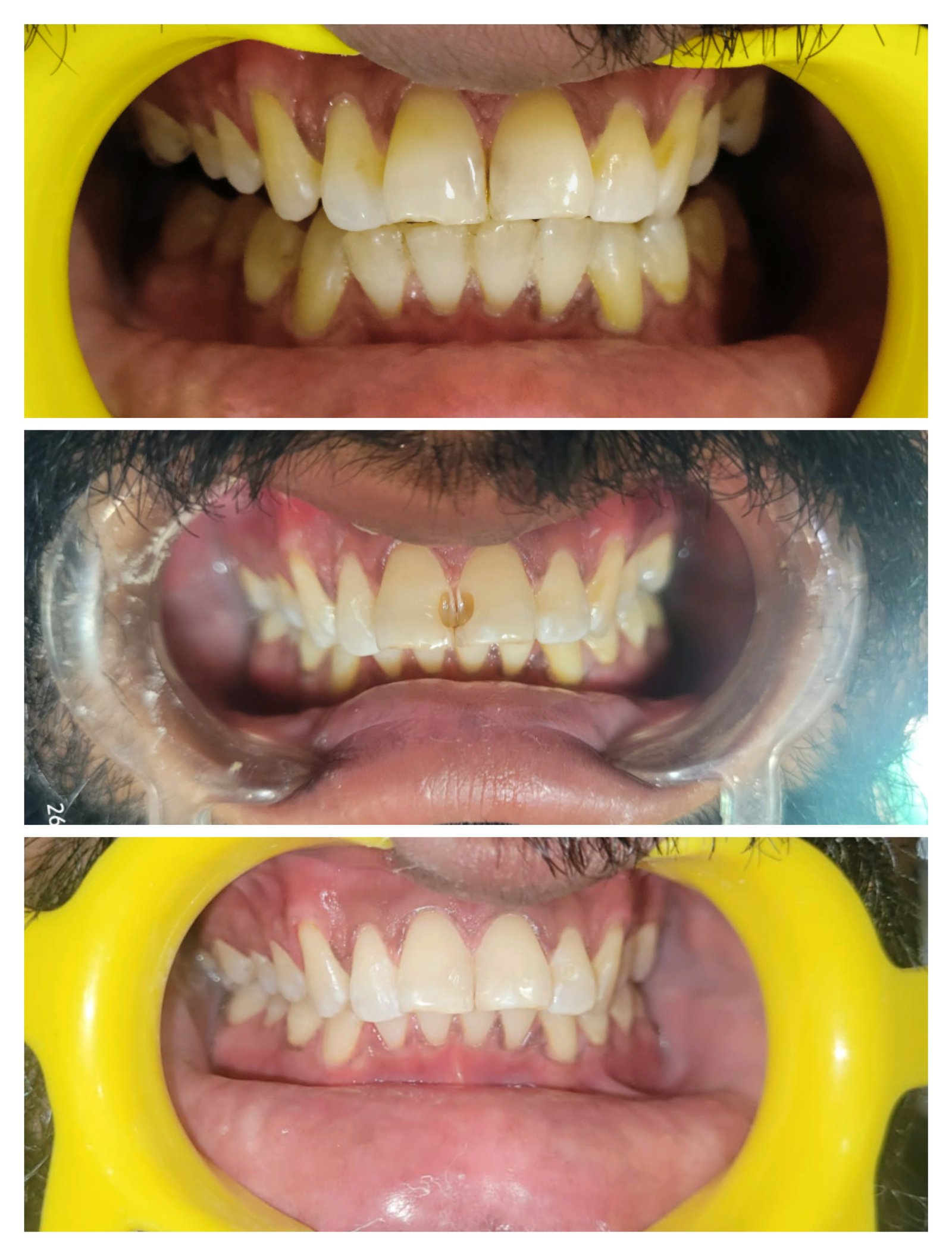 Smile transformation 8