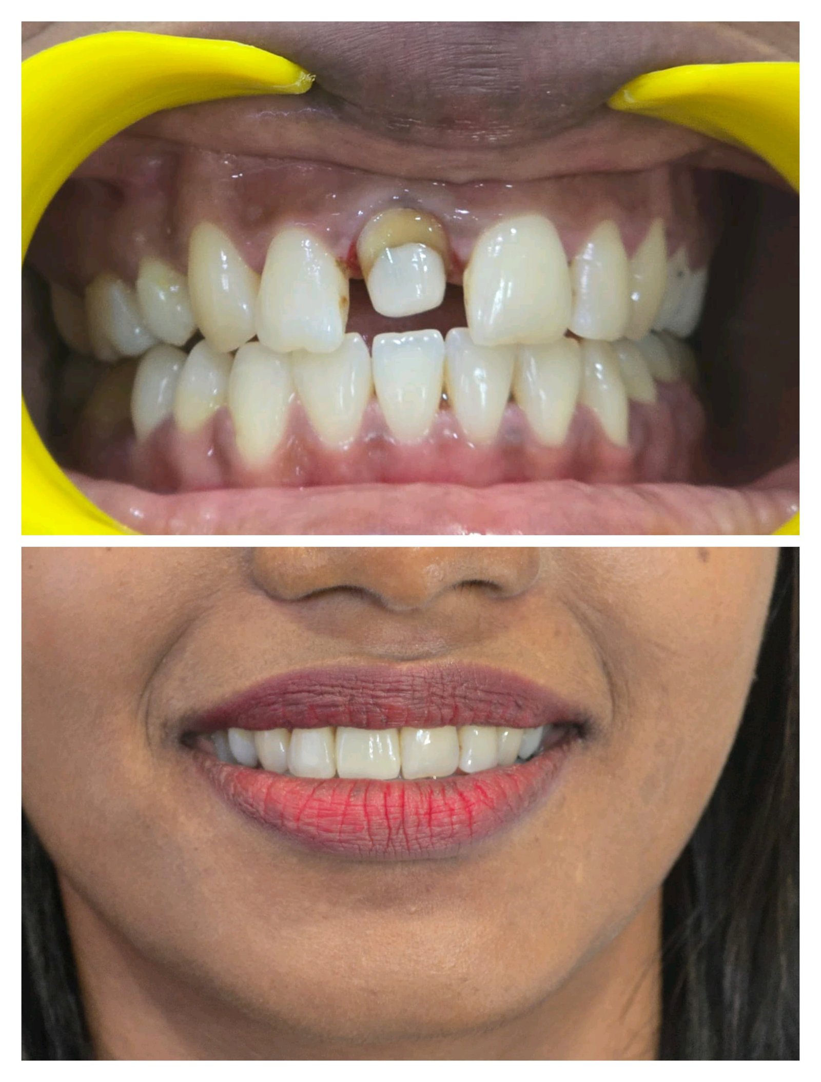 Smile transformation 9