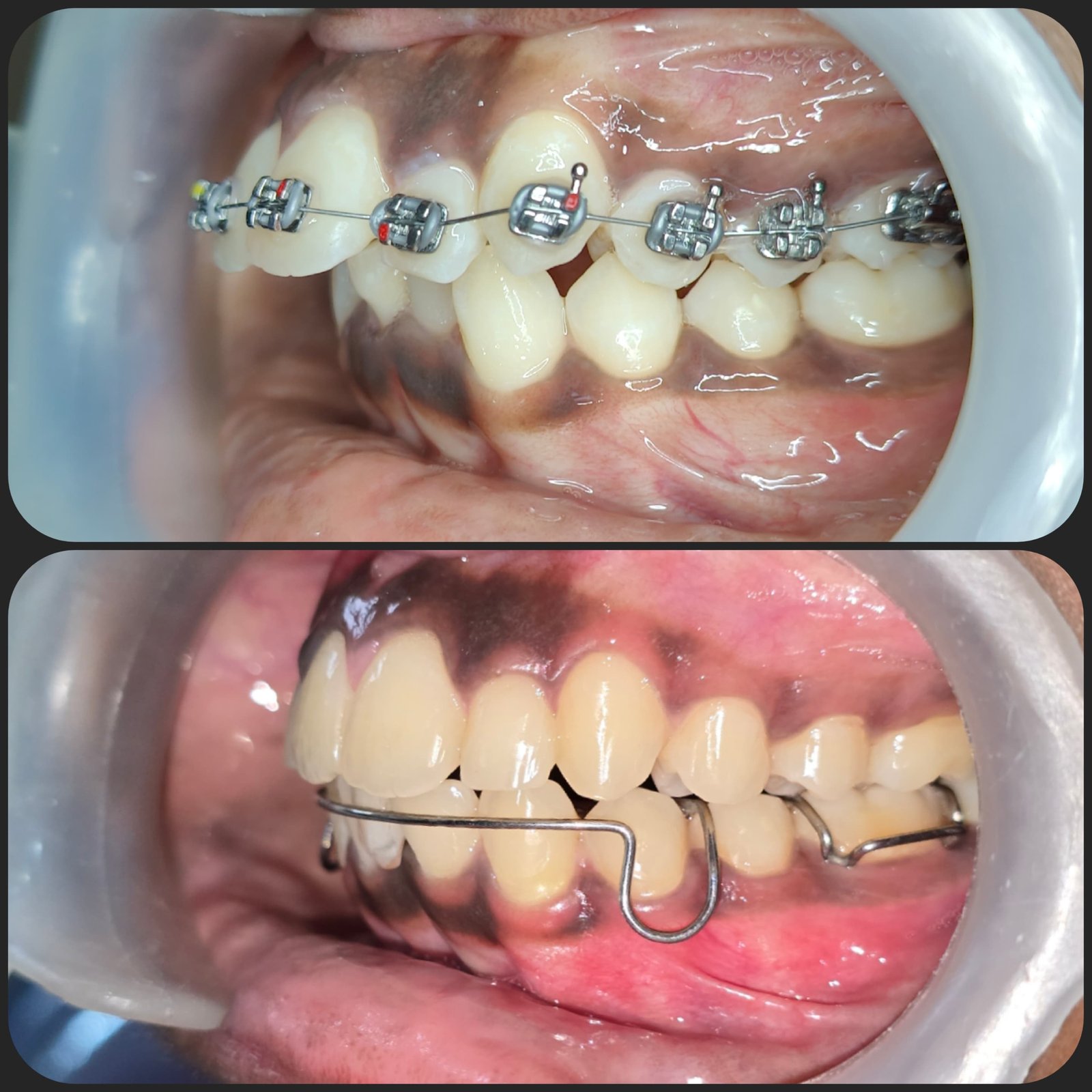 Smile transformation 14