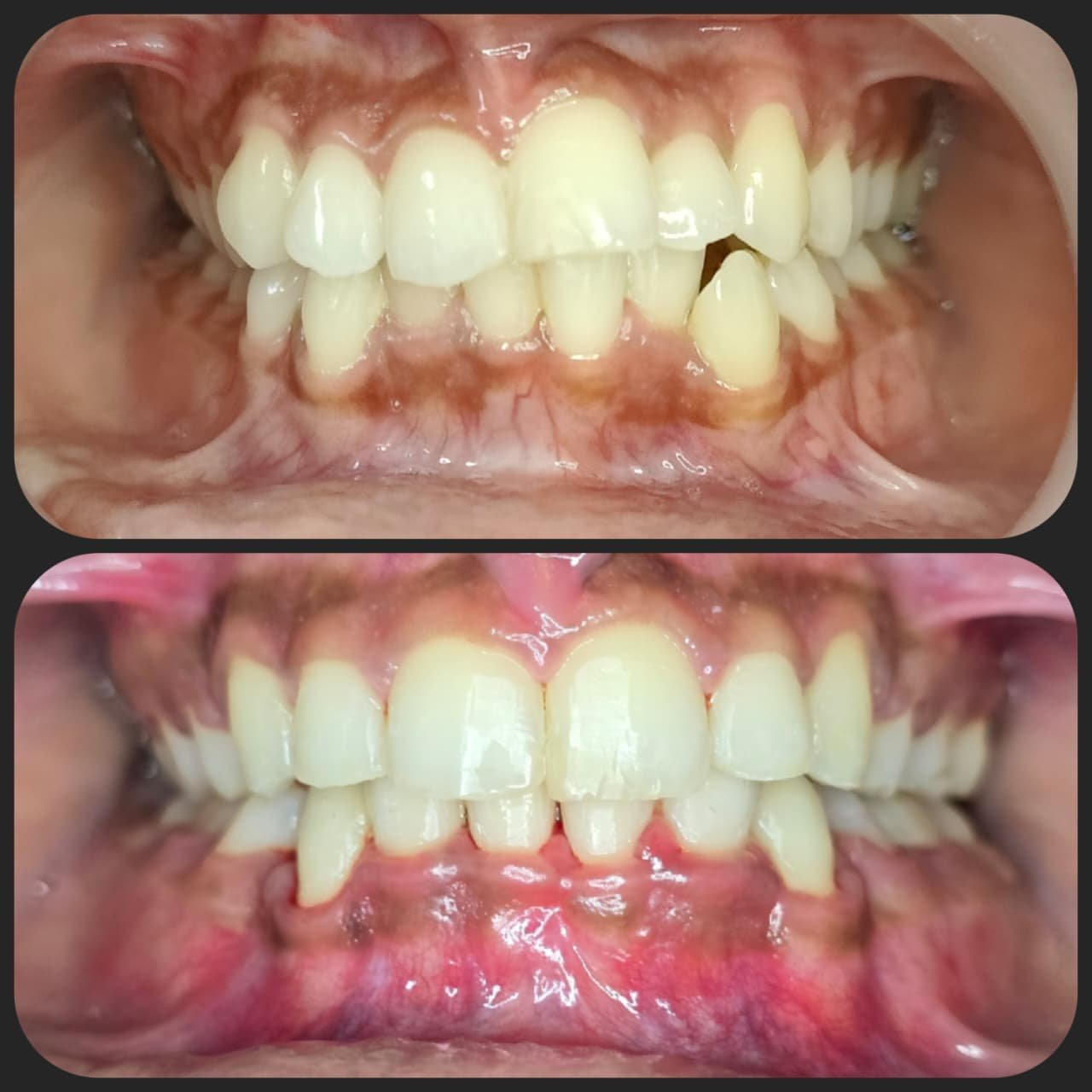 Smile transformation 17