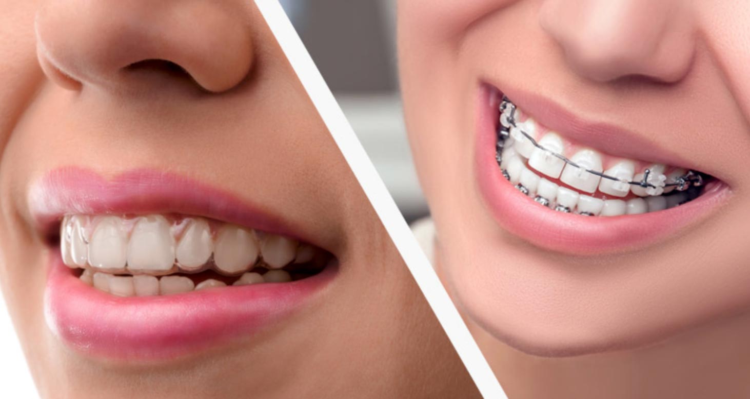 Orthodontics & Aligner Treatment